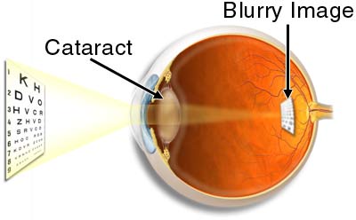cataract