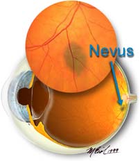 nevus